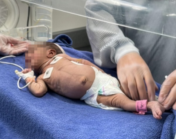 Figura 1. Tétanos neonatal. En la imagen, opistótonos en el paciente 