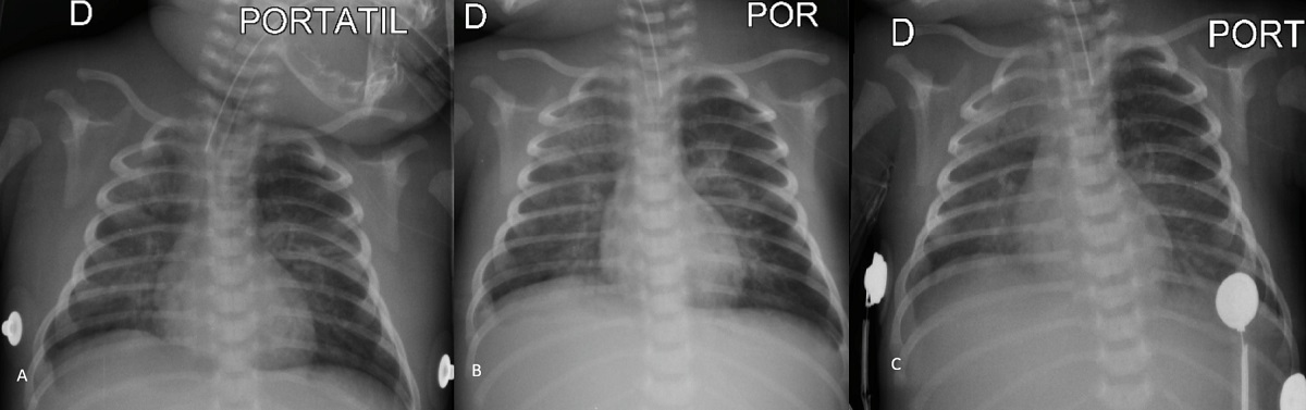 Figura 2. Tétanos neonatal. Serie de radiografías de tórax. A. Infiltrados de ocupación alveolar hacia la región parahiliar izquierda, ápex y base del hemitórax derecho; B. Opacidades intersticiales bilaterales difusas a correlacionar con antecedentes; C. Opacidades intersticiales bilaterales difusas.