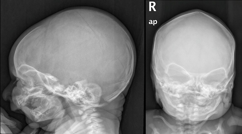 Figura 1. Caídas neonatales. Radiografía craneal lateral y anteroposterior: fractura lineal parietal izquierda en neonato de 48 horas de vida