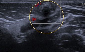 Figura 3. Pilomatrixoma cervical pediátrico
