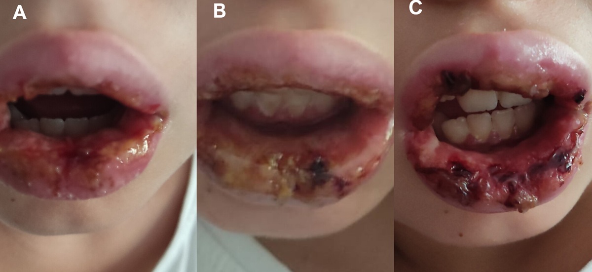 Figura 1. Mucositis inducida por Mycoplasma pneumoniae. Evolución de las lesiones vesiculosas orales. A (primer día), B (segundo día) y C (tercer día). 