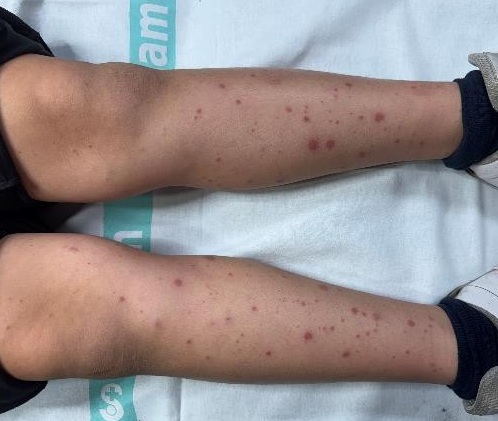 Figura 1. Púrpura palpable característica de la vasculitis por IgA (púrpura de Schönlein-Henoch), de distribución simétrica en miembros inferiores