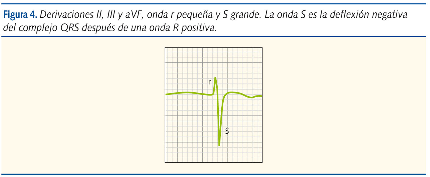 Figura 4. Derivaciones II, III y aVF, onda r pequeña y S grande. La onda S es la deflexión negativa del complejo QRS después de una onda R positiva.