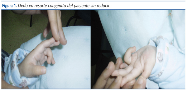 Figura 1. Dedo en resorte congénito del paciente sin reducir.