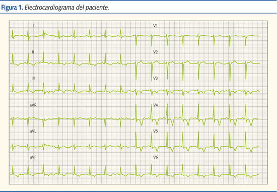 Figura 1. Electrocardiograma del paciente.